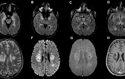 Recovered COVID Patients Suffering ‘Significant Cognitive Deficits’